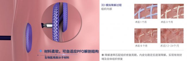 内蒙古自治区妇幼保健院成功实施首例生物可降解卵圆孔封堵术 内蒙古自治区妇幼保健院成功实施首例生物可降解卵圆孔封堵术